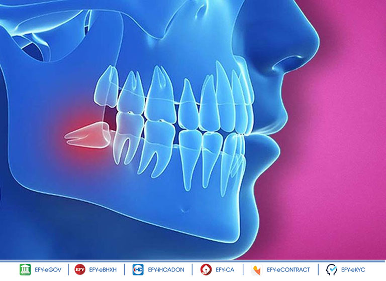 Nhổ răng khôn do mọc lệch ảnh hưởng đến sức khỏe sẽ được hưởng BHYT